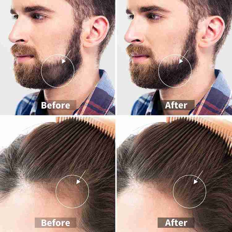 HAIR DERMA ROLLER